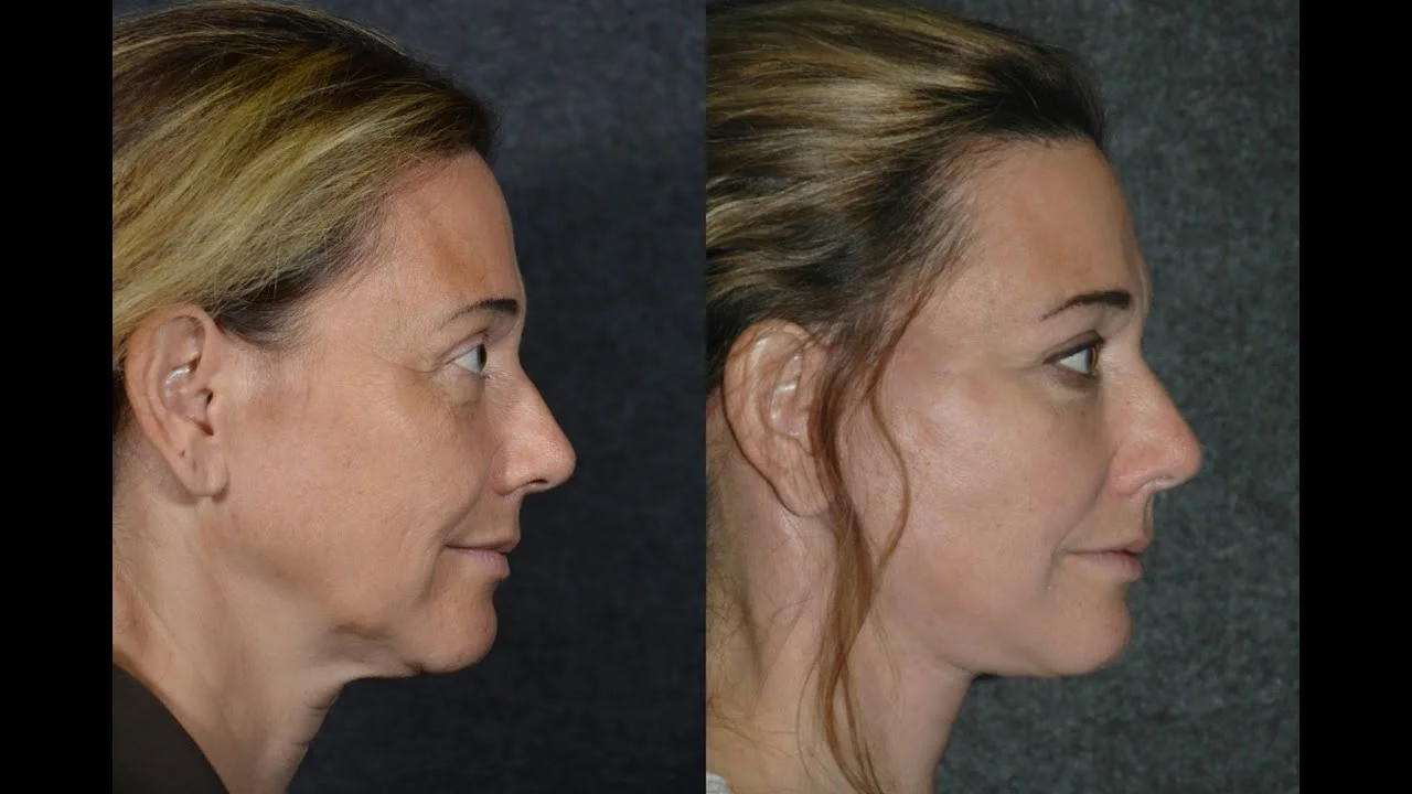Botched Mini Face Lift